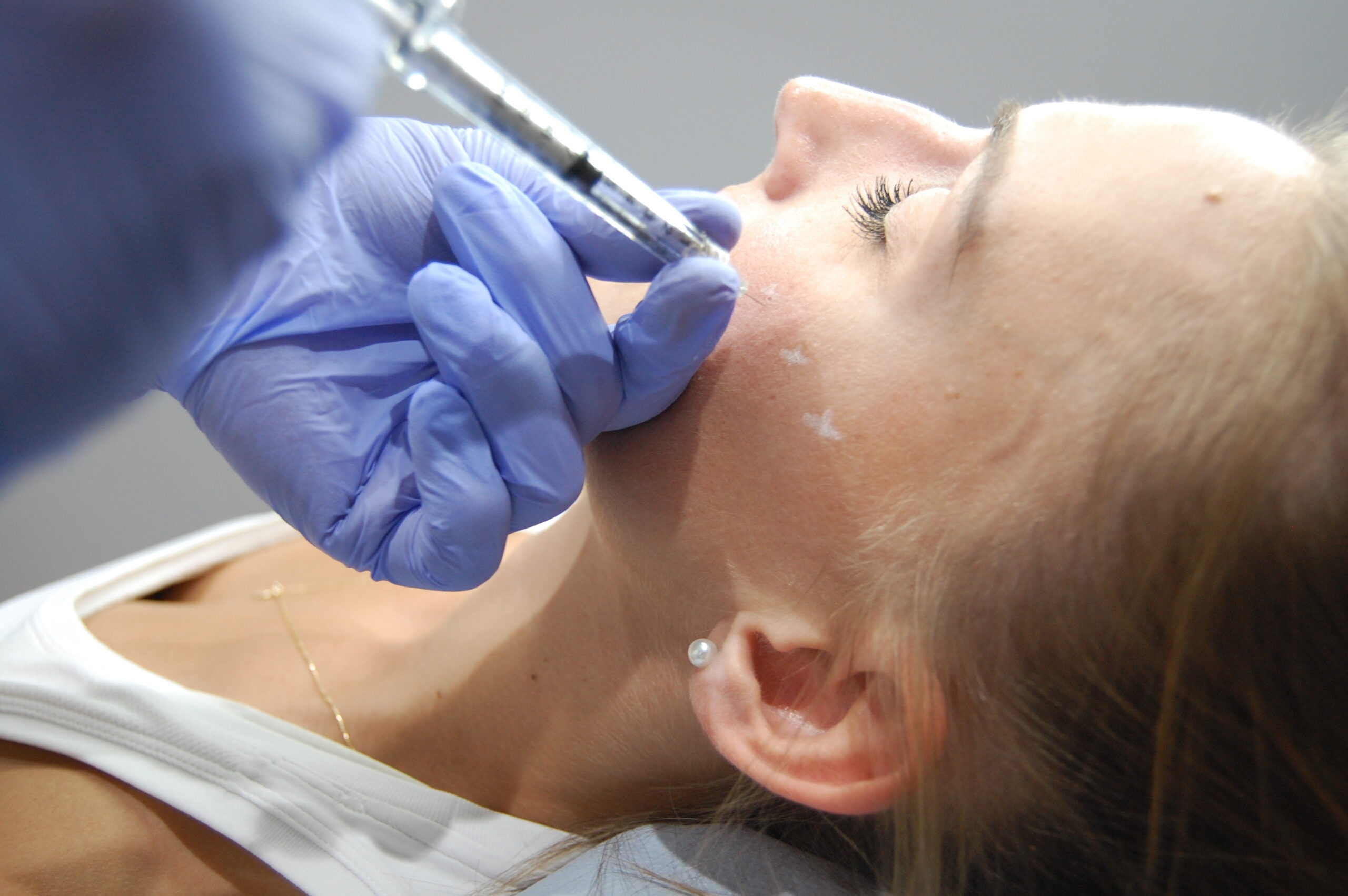 Cheek dermal filler