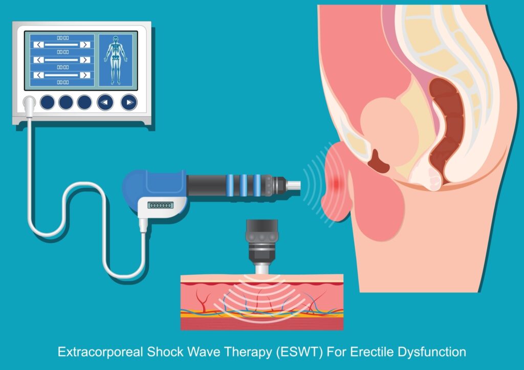 Shockwave for erectile dysfunction
